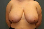 BREAST REDUCTION: Case 47 Before